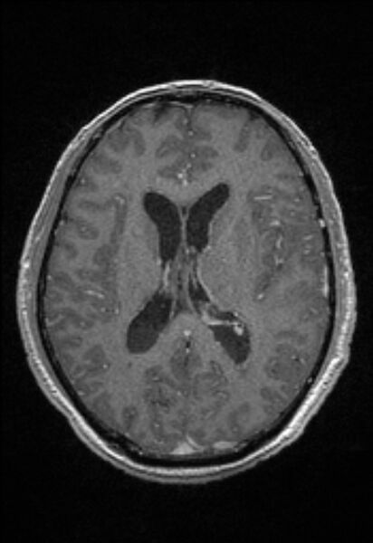 File:Brain abscess with ventriculitis (Radiopaedia 85703-101495 Axial T1 C+ 104).jpg