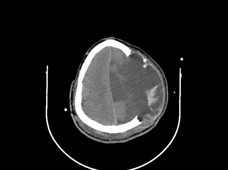 File:Brain injury by firearm projectile (Radiopaedia 82068-96087 B 144).jpg