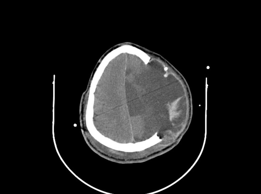Brain injury by firearm projectile (Radiopaedia 82068-96087 B 144).jpg