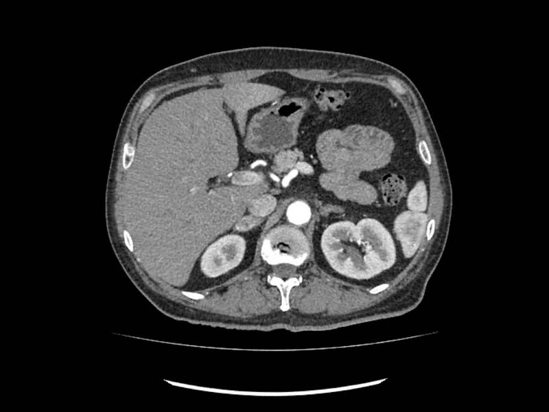 File:Brain metastases from renal cell carcinoma (Radiopaedia 42222-45328 A 39).jpg