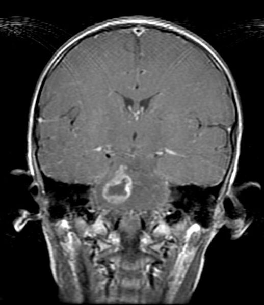 File:Brainstem glioma (Radiopaedia 11250-11614 E 1).jpg