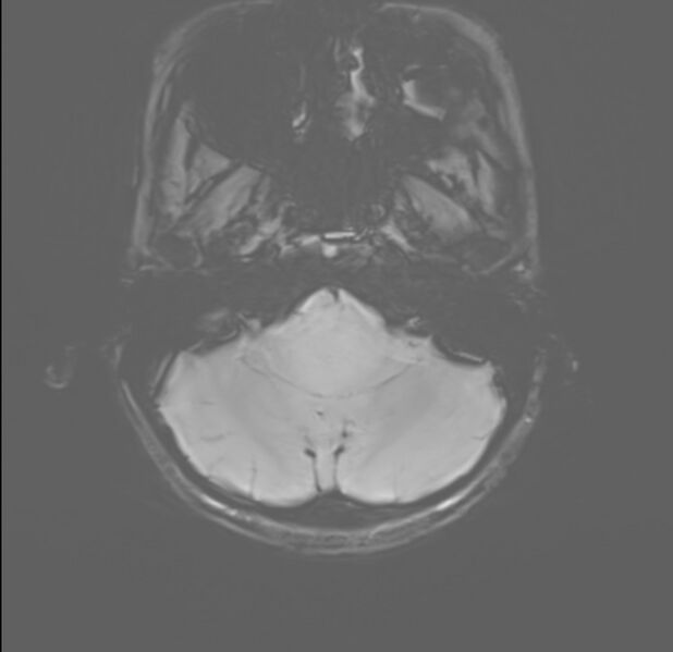 File:Brainstem glioma (Radiopaedia 70548-80674 Axial SWI 6).jpg