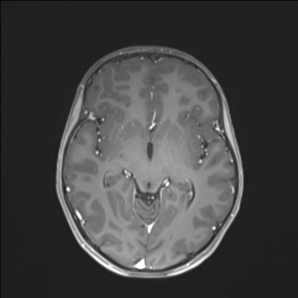 File:Brainstem glioma (Radiopaedia 70548-80674 Axial T1 C+ 76).jpg