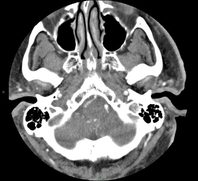 File:Brainstem hemorrhage (Radiopaedia 58794-66028 D 31).jpg