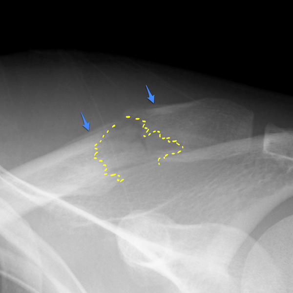 File:Breast cancer metastasis to distal clavicle - pathological fracture (Radiopaedia 12544-18319 Annotated image 1).png