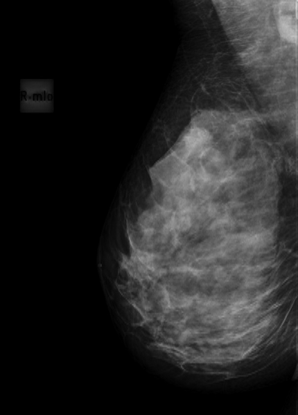 File:Breast carcinoma (Radiopaedia 33083-34110 MLO 1).png