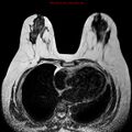 Breast carcinoma (multicentric multifocal in mammary Paget disease) (Radiopaedia 50966-56512 Axial T2 5).jpg