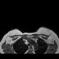 Breast implants - MRI (Radiopaedia 26864-27035 Axial T1 47).jpg