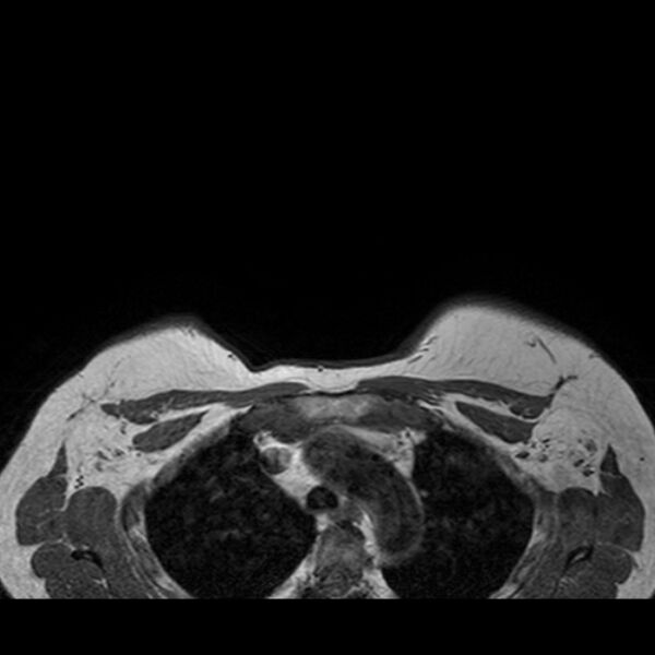File:Breast implants - MRI (Radiopaedia 26864-27035 Axial T1 47).jpg