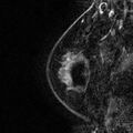 Breast implants - MRI (Radiopaedia 26864-27035 Sagittal T2 10).jpg