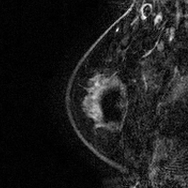 File:Breast implants - MRI (Radiopaedia 26864-27035 Sagittal T2 10).jpg