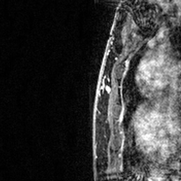 File:Breast implants - MRI (Radiopaedia 26864-27035 Sagittal T2 75).jpg