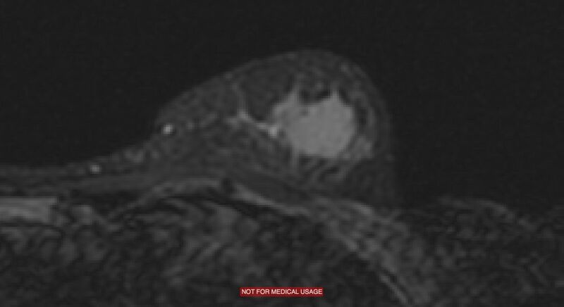 File:Breast lymphoma (MRI) (Radiopaedia 34999-36498 Axial STIR 11).jpg