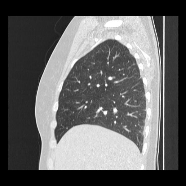 File:Bronchial atresia (Radiopaedia 22965-22992 Sagittal lung window 41).jpg