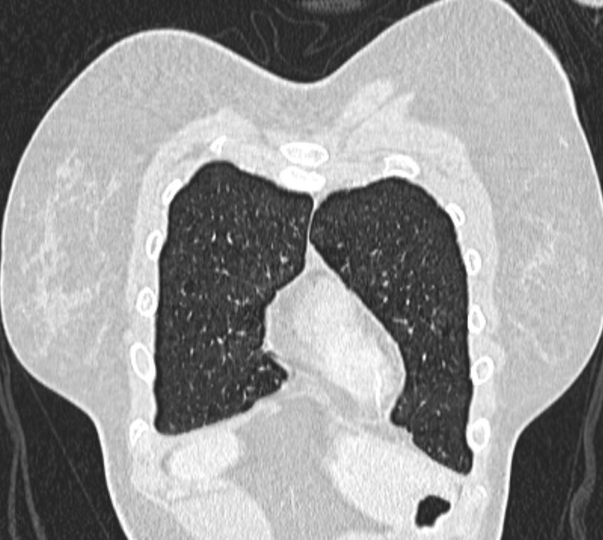 Bronchial atresia (Radiopaedia 50007-55297 Coronal lung window 8).jpg