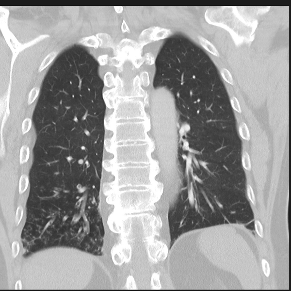 File:Bronchiectasis (Radiopaedia 39385-41666 Coronal lung window 25).png
