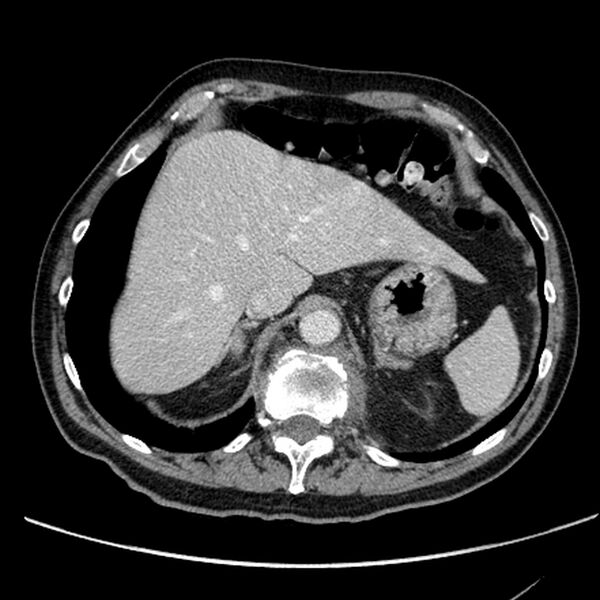 File:Bronchogenic carcinoma with L1 vertebra metastasis (Radiopaedia 9096-9805 Axial C+ delayed 32).jpg