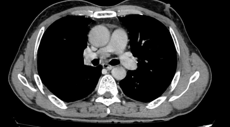 File:Bronchogenic carcinoma with superior vena cava syndrome (Radiopaedia 36497-38054 Axial C+ delayed 45).jpg