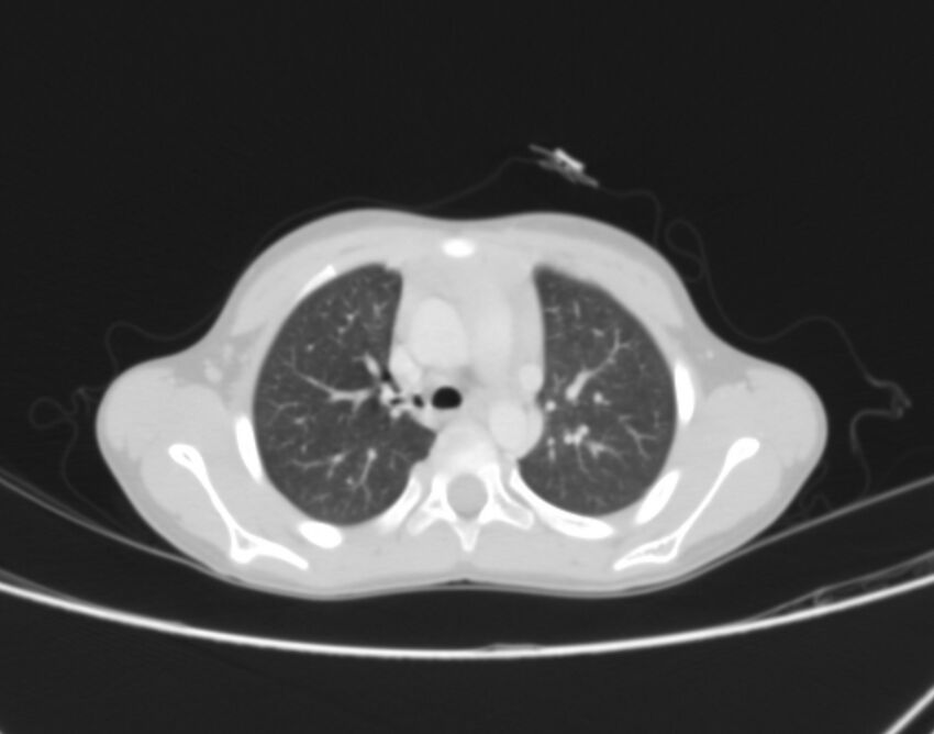 Bronchus suis (Radiopaedia 68131-77620 Axial lung window 18).jpg