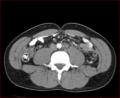 Burned-out testicular choriocarcinoma (Radiopaedia 32822-34040 B 16).PNG