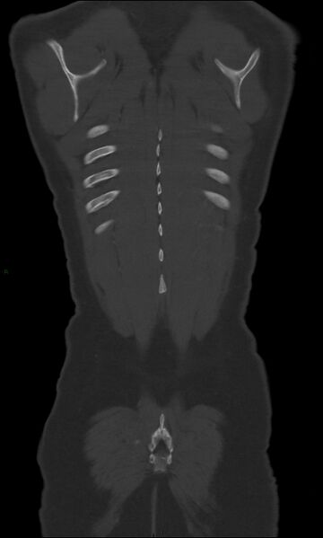 File:Burst fracture (Radiopaedia 83168-97542 Coronal bone window 66).jpg