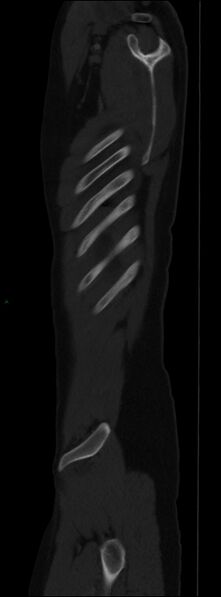 File:Burst fracture (Radiopaedia 83168-97542 Sagittal bone window 110).jpg