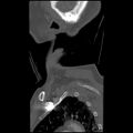 C1 anterior arch (plough) fracture - type 1 (Radiopaedia 76181-87720 Sagittal bone window 8).jpg
