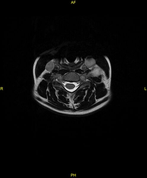 File:C5 nerve sheath tumor (Radiopaedia 85777-101596 Axial T2 32).jpg