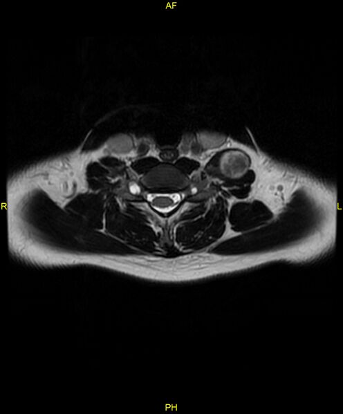 File:C5 nerve sheath tumor (Radiopaedia 85777-101596 Axial T2 55).jpg