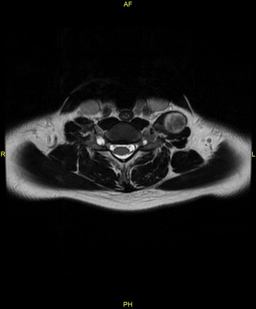C5 nerve sheath tumor (Radiopaedia 85777-101596 Axial T2 55).jpg