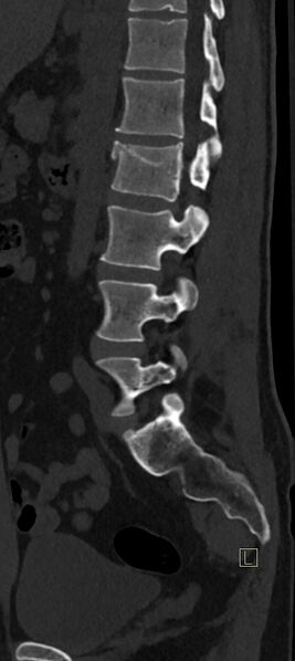 File:Calcaneal fractures with associated L2 burst fracture (Radiopaedia 71671-82493 Sagittal bone window 25).jpg