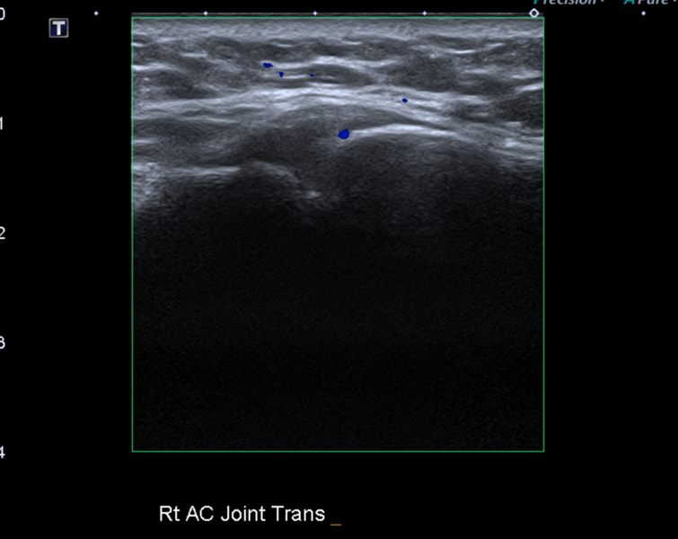File:Calcific tendinitis (ruptured) (Radiopaedia 56393-63053 A 29).png
