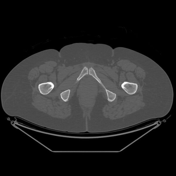 File:Calcific tendinitis of the gluteus medius muscle (Radiopaedia 66998-76318 Axial bone window 68).jpg