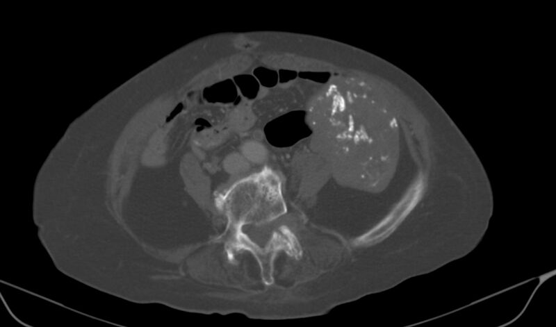 File:Calcified fibroids (Radiopaedia 20306-20228 Axial bone window 6).jpg