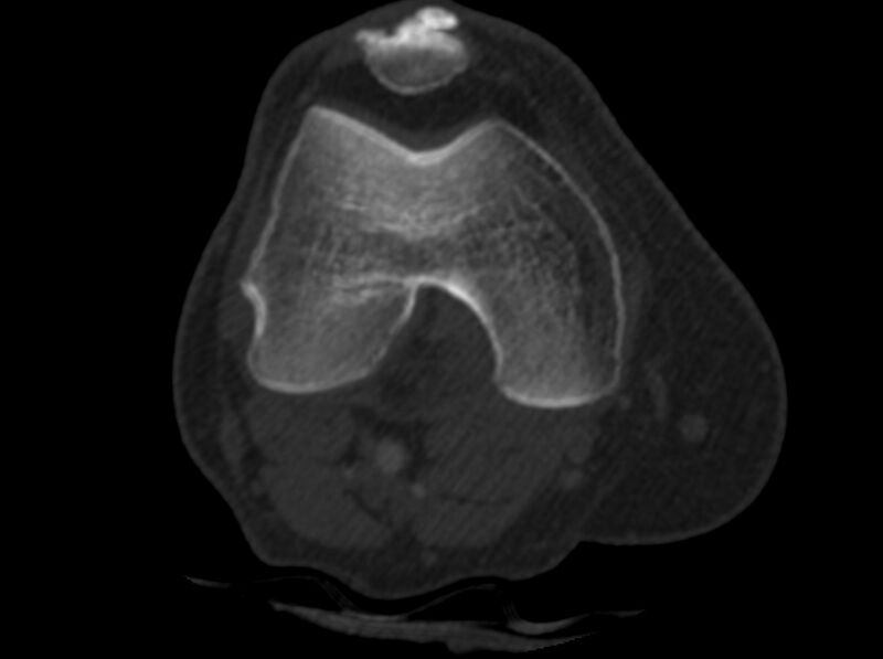 File:Calcified hematoma - popliteal fossa (Radiopaedia 63938-72763 C 1).jpg