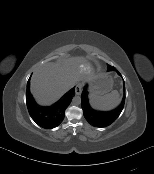 File:Calcified hepatic hydatid cyst (Radiopaedia 81127-94738 Axial non-contrast 12).jpg