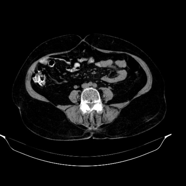 File:Calcified hydatid cyst (Radiopaedia 62000-70085 Axial non-contrast 68).jpg