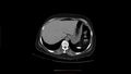 Calcified spleen (Radiopaedia 60952-68768 Axial non-contrast 2).jpg
