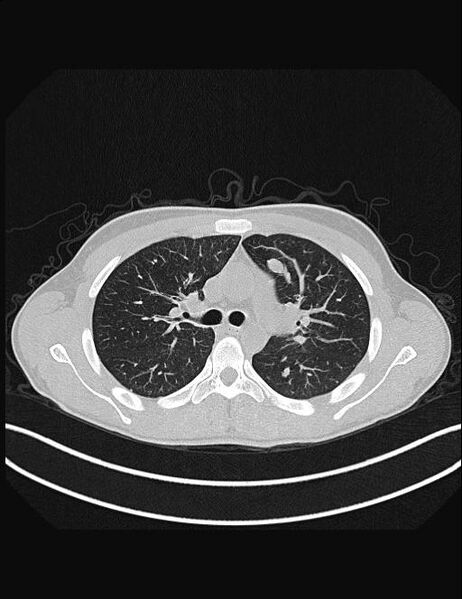 File:Calcifying pulmonary metastases (Radiopaedia 33359-34396 Axial lung window 23).jpg