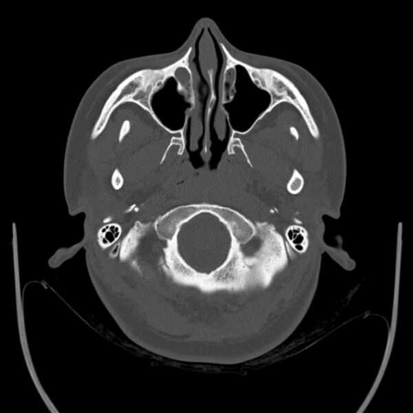 File:Calvarial osteoma (Radiopaedia 36520-38079 Axial bone window 13).jpg