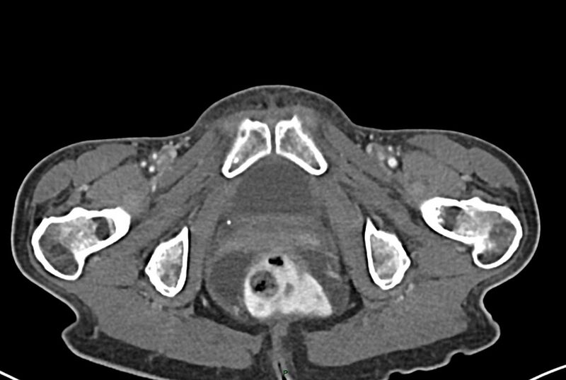 File:Carcinoid mesenteric tumor complicated by chylous ascites (Radiopaedia 76312-87953 A 81).jpg