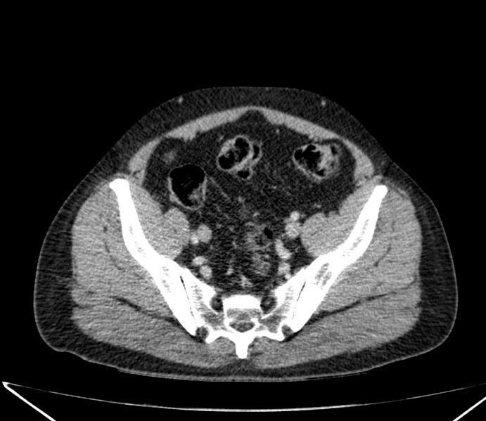 File:Carcinoid tumor with hepatic metastases (Radiopaedia 22651-22670 C 67).jpg