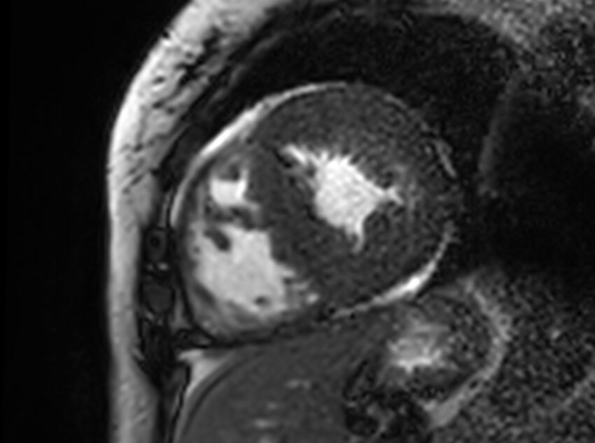 Cardiac amyloidosis (Radiopaedia 61600-69579 Short axis bSSFP 123).jpg