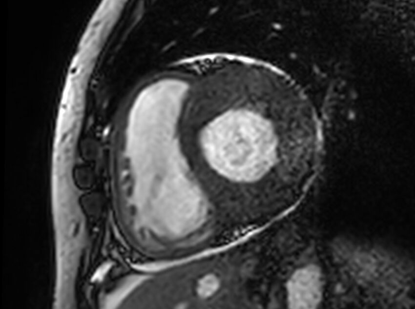 Cardiac amyloidosis (Radiopaedia 61600-69579 Short axis bSSFP 264).jpg
