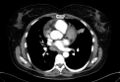 Cardiac sarcoidosis (Radiopaedia 74548-85534 A 44).jpg
