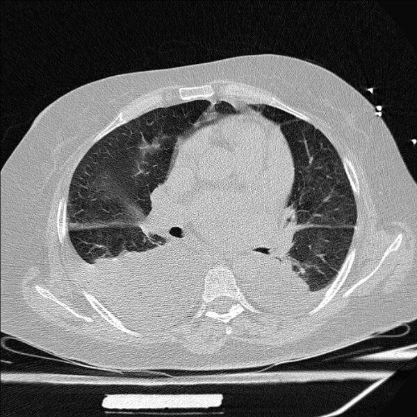File:Cardiogenic pulmonary edema (Radiopaedia 29213-29609 Axial lung window 46).jpg