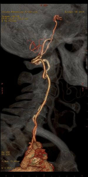 File:Carotid artery stenosis (Radiopaedia 28786-29086 B 11).jpg