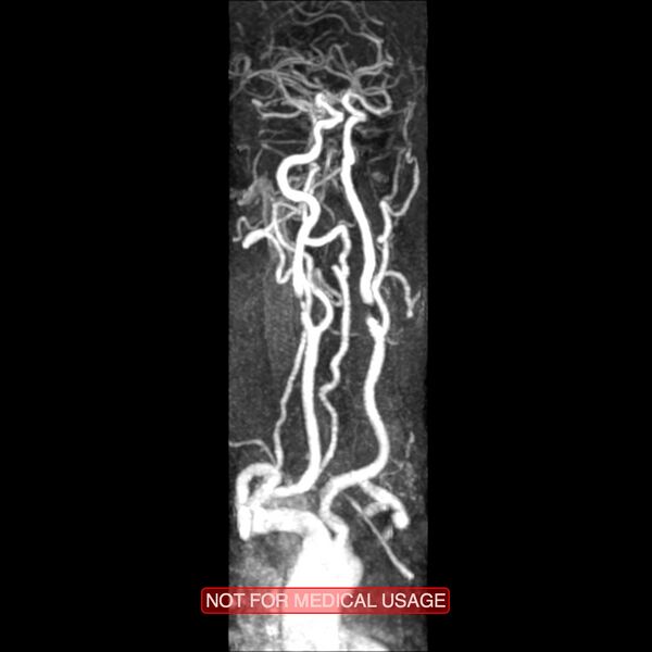 File:Carotid artery stenosis (Radiopaedia 28786-29087 3D MRA 3).jpg