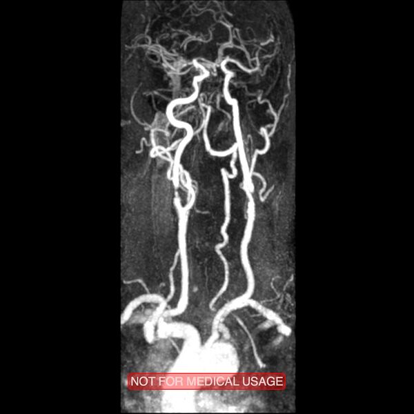 File:Carotid artery stenosis (Radiopaedia 28786-29087 3D MRA 5).jpg