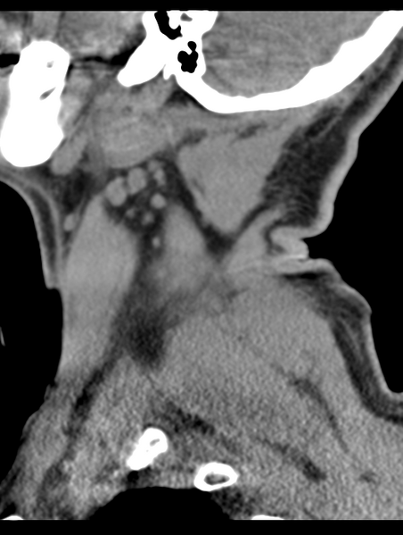 File:Cavernoma of cervical cord (Radiopaedia 50838-56346 B 10).png